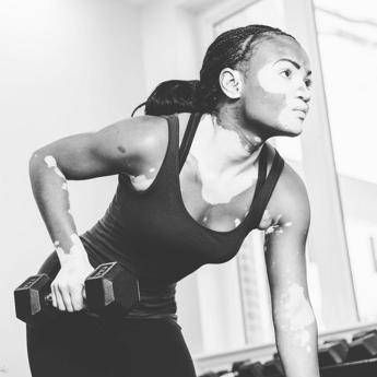 E’ la Vitiligine week