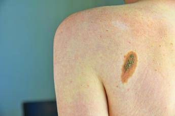 Prevenzione melanoma
