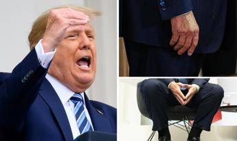 Trump e le gambe gonfie